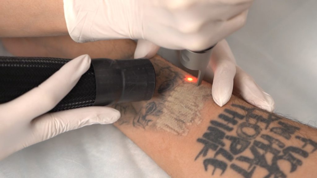 Лазерное удаление татуировок на аппарате Picosure
